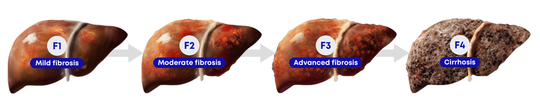 Liver fibrosis progression from F1 to F4
